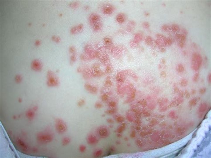 Can bacteria cause skin rash?