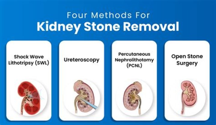 Can kidney stone be cured by homeopathy?