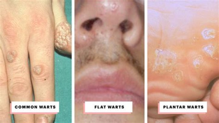 Can you pop warts?