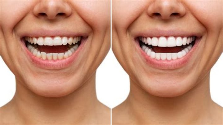 Do you smile with teeth closed?