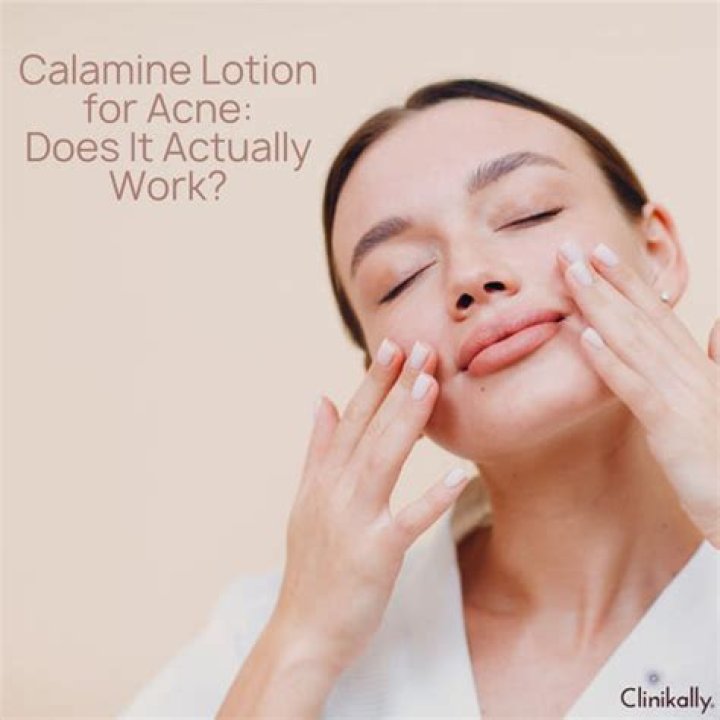Does calamine help with acne?