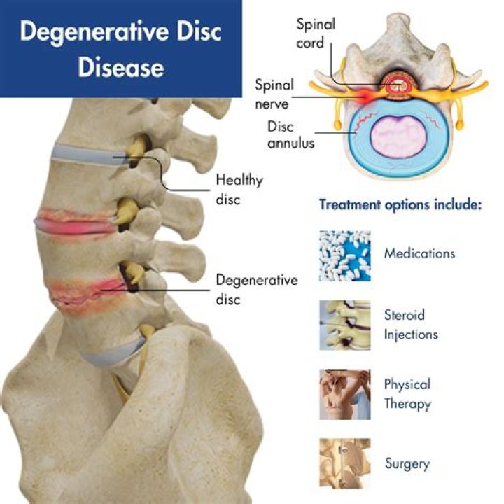Does everyone get degenerative disc disease?