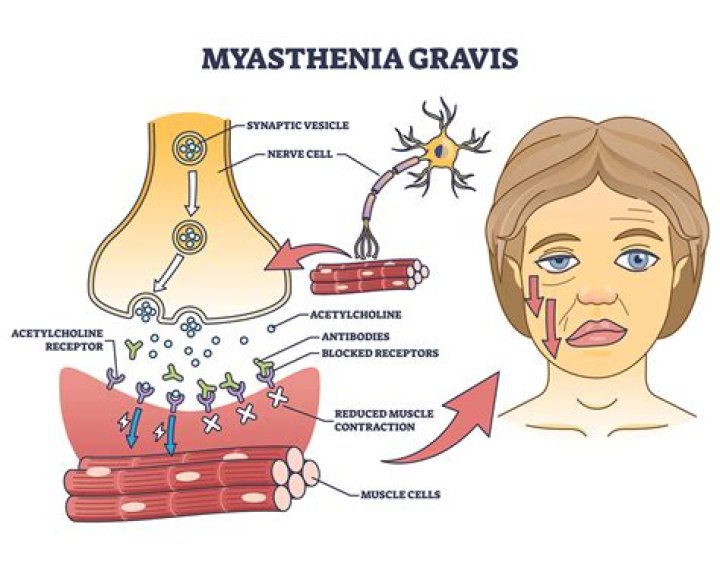 Does myasthenia cause paralysis? | ContextResponse.com