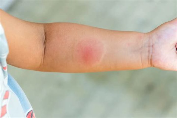 Does putting a hot spoon on a mosquito bite work?