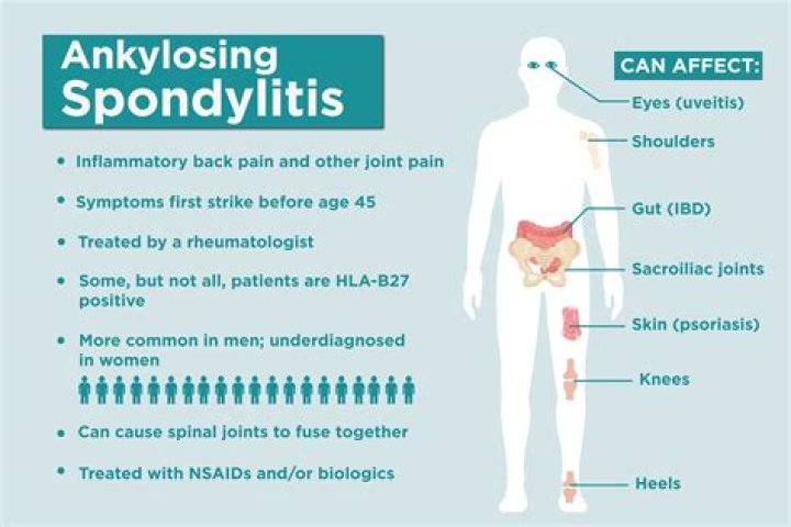 How do doctors test for ankylosing spondylitis?