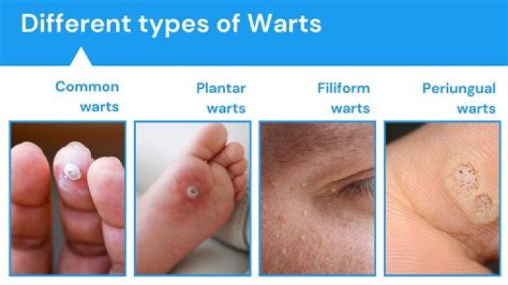 How do kids get warts?