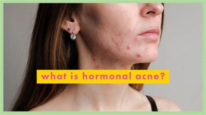 How do you deal with hormonal acne?