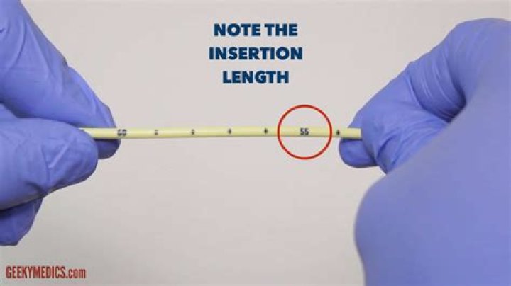 How do you measure an NG tube?
