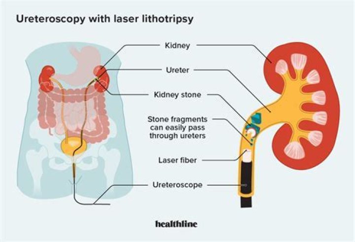 How long does it take to recover from Ureteroscopy?