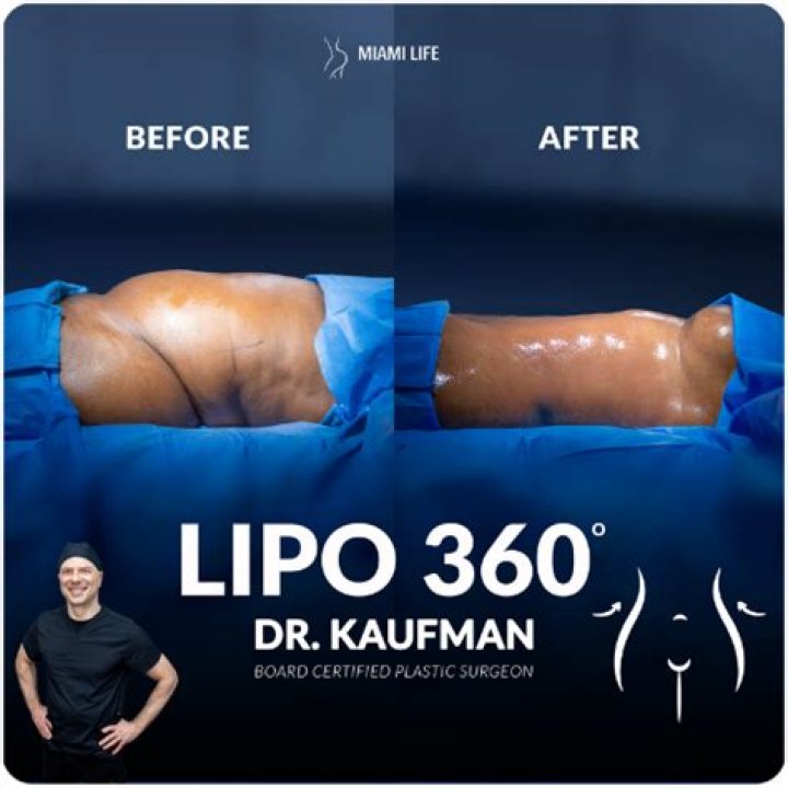 How much can lipo remove?