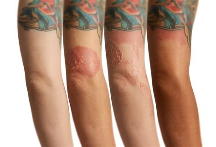 Is it normal to get sick after getting a tattoo?