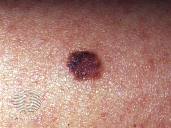 Is melanoma flat or raised?