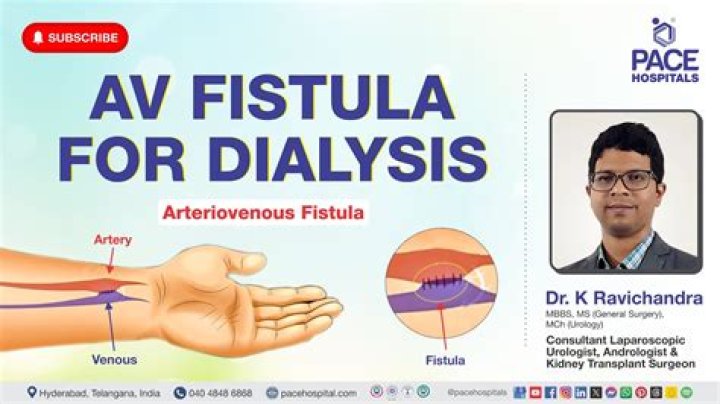 Should an AV fistula have a thrill?