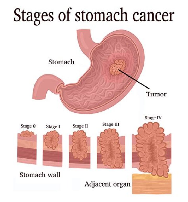 What happens to the cells when you have stomach cancer?