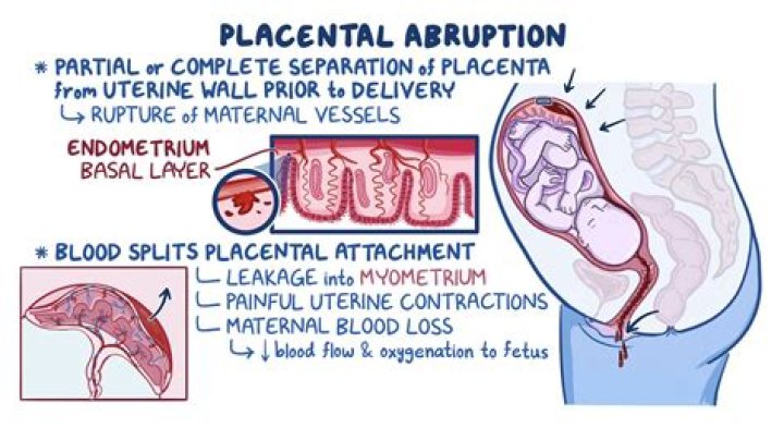 What is a marginal placental abruption?