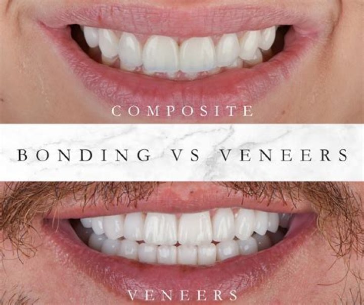 What is better composite or porcelain veneers?