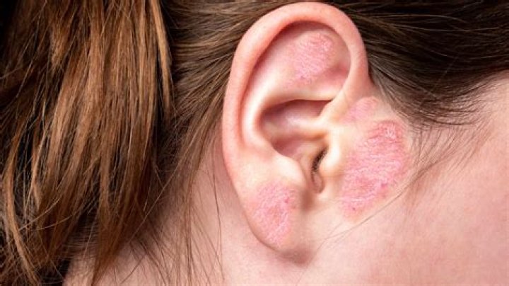 Why are my ears bumpy?