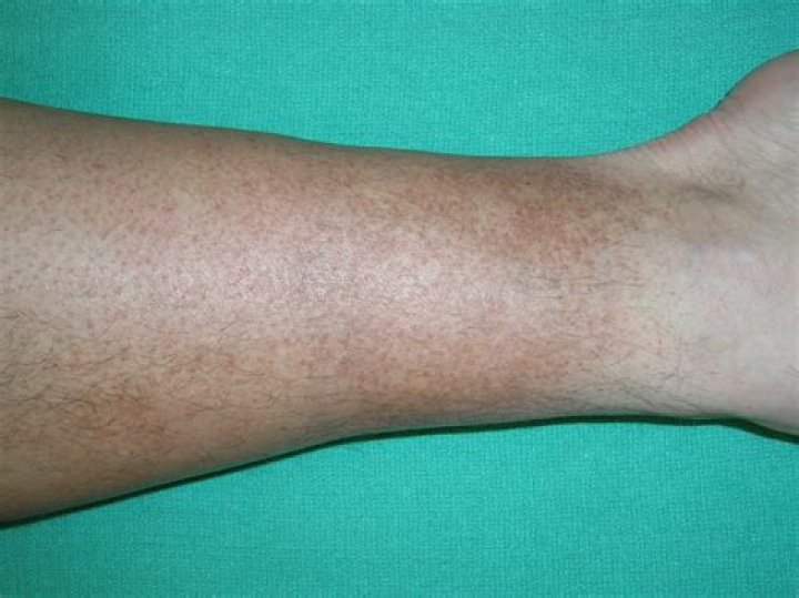 Why do my legs get blotchy?
