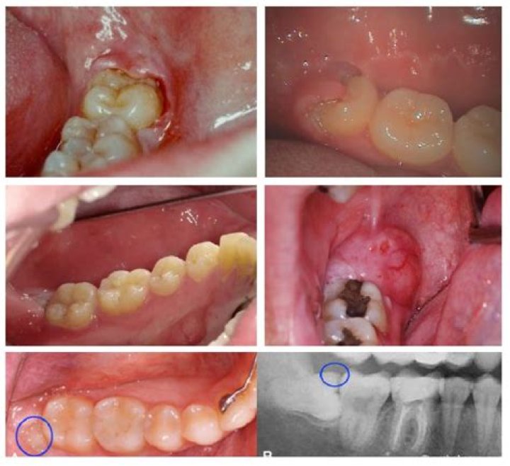 Why is my gum coming over my tooth?